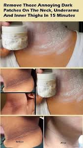 Remove Those Annoying Dark Patches On The Neck Underarms And Inner Thighs In 15 Minutes Skin Care Remedies Dark Underarms Natural Skin Care