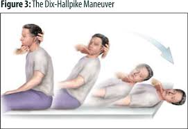 Image result for Canalith Repositioning Procedure