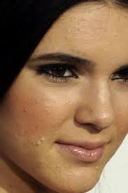 Check spelling or type a new query. Ciresse On Twitter Remember When Kendall Jenner Had Severe Acne Problems How Did She Do It She Looks Really Flawless Now Loveher Http T Co Sboxuoqclz