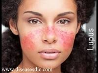 Lupus, technically known as systemic lupus erythematosus (sle), is an autoimmune disease in which the body's immune system mistakenly attacks healthy tissue in many parts of the body. Lupus History Symptoms And Prevention
