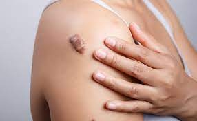 Keloid Scar Treatment Skin Surgery Clinic