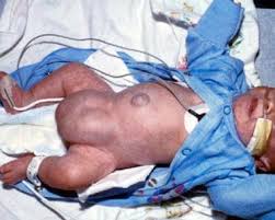 Image result for Inguinal hernia child