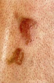 We did not find results for: Diabetes Mellitus Knowledge Amboss