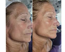 First time doing the Phyto Led Serum with the Celluma Pro & boy am I  excited for what's to come. Roccoco Botanicals you rock!!!