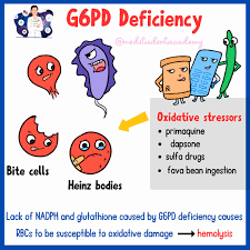 Image result for G6PD Deficiency