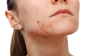Symptoms of anaphylaxis generally include two or more of the following body systems: Food Allergies And Acne What Your Face Is Trying To Tell You