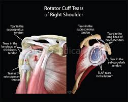 Shoulder anatomy is an elegant piece of machinery having the greatest range of motion of any joint in the an image depicting shoulder anatomy can be seen below. Partial Rotator Cuff Tear Do You Really Need A Surgery Caring Medical Florida