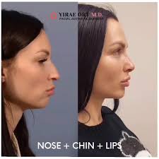 Revision deep plane face and neck lift was performed along with the lower  blepharoplasty and the fractionated CO2 laser resurfacing to address my  patient's goals. Dynamic wrinkles were softened with neurotoxin injections.