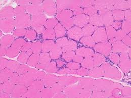 Image result for Polymyositis