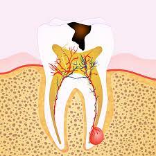 7 Warning Signs You Might Need Root Canal Treatment Glenroy Dental