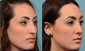 Nose bumps may seemingly pop out of nowhere or you may have been born with them. Rhinoplasty Ontario Dr Oakley Smith Surgeon
