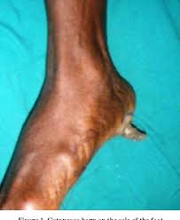 Image result for cornu cutaneum)