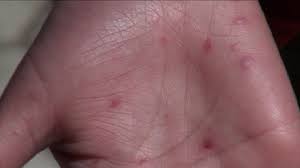 Hand Foot And Mouth Disease Outbreak In Thimphu Bbs