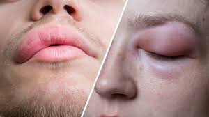 Image result for Angioedema