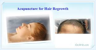 Hair loss can be caused by bad diet habits, skin reactions, heredity or stress. Acupuncture Massage Clinic Scarborough Acupuncture For Hair Loss Does It Work