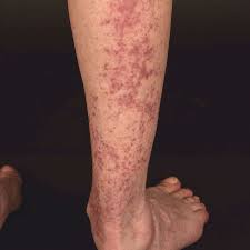 Paraneoplasic forms are described but remain exceptional. Vasculitis Leukocytoclastic Non Iga Associated Altmeyers Encyclopedia Department Vascular Medicine