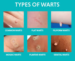 Image result for genital warts
