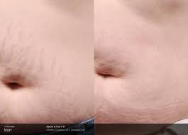 Other treatment options for removing stretch marks. Scar Removal Stretch Mark Treatment Reno Eye Care Professionals