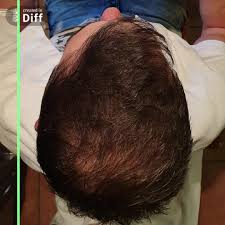 Hair salon in kingston upon hull. Dr Alexander S Hair Loss Clinic Bedfordview Facebook