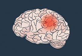 How To Prevent A Second Stroke Health Essentials From Cleveland Clinic