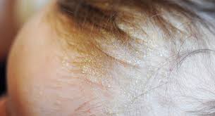 Image result for dry scabs on the head in children