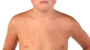 Gli streptococchi di tipo a in genere infettano le mucose. Quarta Malattia O Scarlattinetta Come Riconoscerla Uppa It