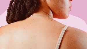 Vaginal Skin Tags Causes Removal And More