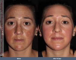 Image result for Melasma