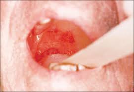 Image result for Physical injury red spots roof of mouth