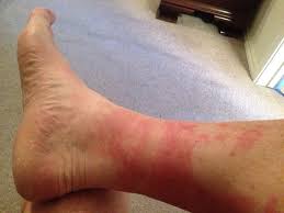 Maybe you would like to learn more about one of these? Disney Rash What It Is How To Treat It How To Prevent It In The First Place Your Mileage May Vary