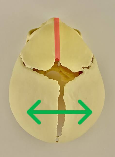 Metopic Craniosynostosis