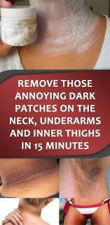 Remove Those Annoying Dark Patches On The Neck Underarms And Inner Thighs In 15 Minutes Healthbeauty365 Xyz In 2020 Inner Thigh Natural Remedies For Allergies Patches