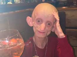 18-Year-Old Dies With Body Of A 144-Year-Old Due To 'Benjamin Button  Disease'