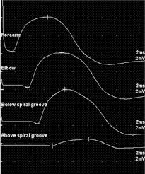 Spiral groove products are developed and manufactured in berkeley, california. Acute Radial Neuropathy At The Spiral Groove Following Massage A Case Presentation Sciencedirect