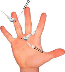 Image result for phlegmon of hand)