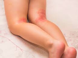 As cute as cats may be, their hair can sometimes promote neurodermatitis. Neurodermitis Bei Babys Erkennen Allcon