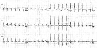 Paediatric Ecg Interpretation Litfl Medical Blog Ecg