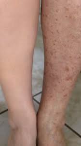 Tried Tested Here S The Only Solution Recommend By Beauty Experts To Clear Up Dark Spots Age Spots Diy Acne Treatment Dark Spots Acne Treatment Overnight