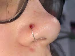 Got My Nose Pierced January 27th 2018 This Popped Up About A Month Ago I Had A Stud But The Bump Started Growing Over It So I Had To Get A Ring