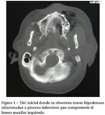 Tratamiento exitoso de una mucormicosis rinocerebral persistente en un paciente pediátrico durante el debut de una leucemia aguda. Mucormicosis Rinocerebral De Origen Dental Reporte De Un Caso Clinico Y Revision De La Literatura