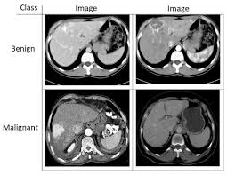 tumors can grow from the brain tissue itself (primary), or cancer from elsewhere in the body can spread to the brain (metastasis). Sensors Free Full Text A Novel Method For Classifying Liver And Brain Tumors Using Convolutional Neural Networks Discrete Wavelet Transform And Long Short Term Memory Networks Html
