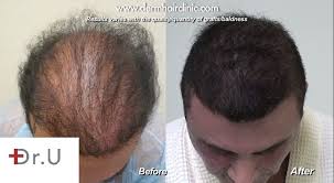 Our hair replacement system is suitable for cases of severe or total hair loss and offers a comfortable and attractive alternative to wigs. Facial Hair To Head Transplant Using Ugraft Los Angeles 310 318 1500