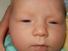 Eyelid Issue April 2014 Babies Forums What To Expect