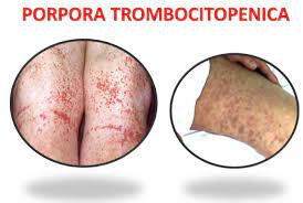This is due to a low number of blood cell fragments called platelets. Porpora Trombocitopenica Idiopatica