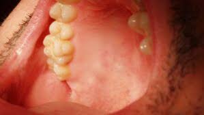 Image result for Canker sores symptoms roof of the mouth