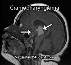 Craniopharyngiomas Diagnostic Imaging Radiology Imaging Brain Anatomy