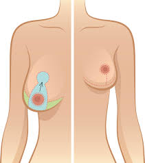 Loverme can perform areola reduction on its own or as part of a more extensive surgery such as breast lift, breast reduction, or gynecomastia (male breast reduction) surgery. Breast Reduction And Breastfeeding Breastfeeding Support