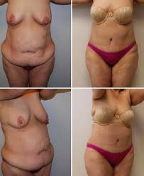 Shortens your hospital stay (typically one night). Gastric Bypass Reconstruction San Diego Coastal Plastic Surgeons