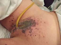 Consider repletion if <50k with bleeding or <20k without bleeding. A Young Woman With Fever Generalized Weakness And A New Rash Everyday E B M