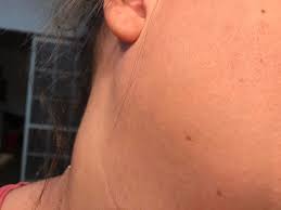 Ingrown hair symptoms may resemble other skin care problems. Pcos Facial Hair Electrolysis How I Deal With It Hirsutism My Pcos Kitchen
